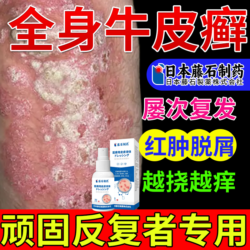 药监备案】牛皮癣银屑病真菌感染