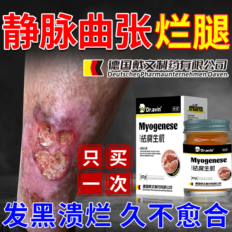 【德国品牌】脉管炎静脉曲张
