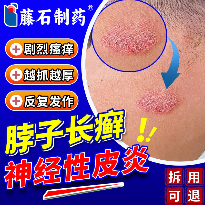 脖子上长癣痒神经性皮炎外用膏过敏瘙痒刺挠真菌感染OA