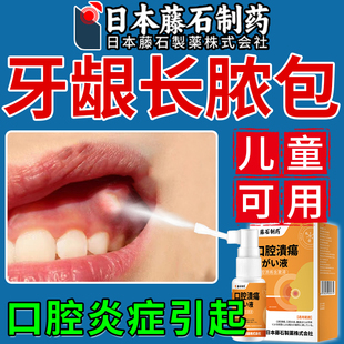 儿童牙龈长脓包喷剂牙龈肿痛牙齿萎缩牙痛牙根发炎牙周炎搭牙膏xu