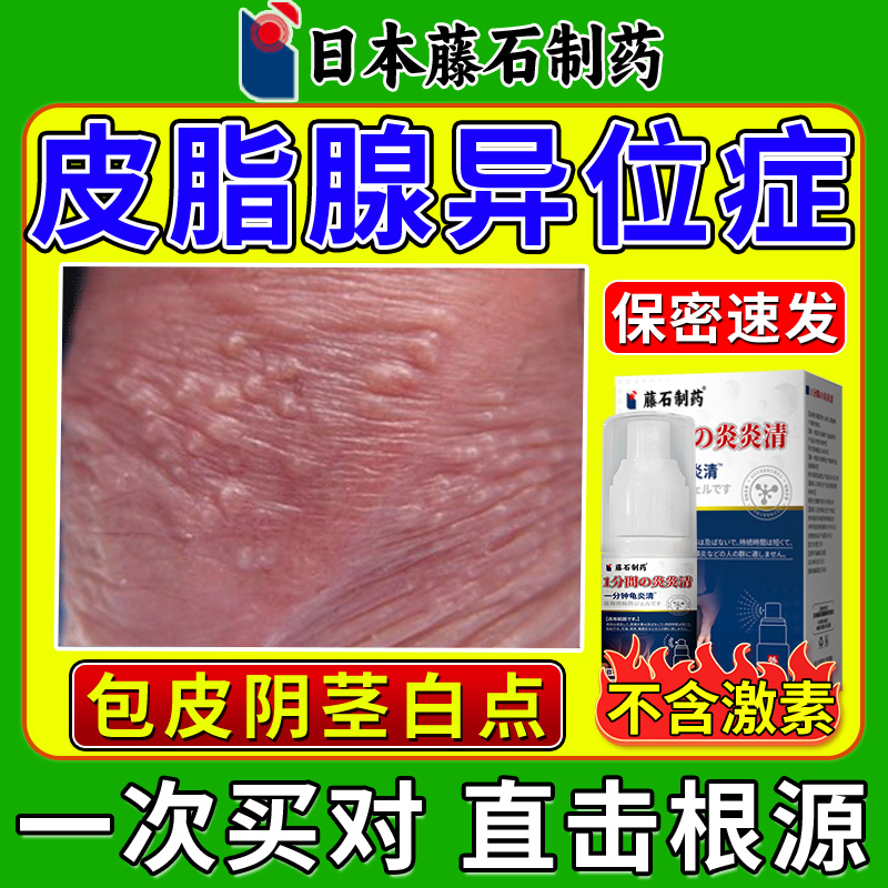 日本皮脂腺异位症包皮阴茎小疙瘩白点冠状沟珍珠丘疹喷剂非膏药vb