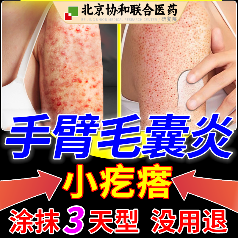 手臂毛囊炎胳膊上长的小疙瘩专门用效特鸡皮肤去除疙瘩毛囊角化oa