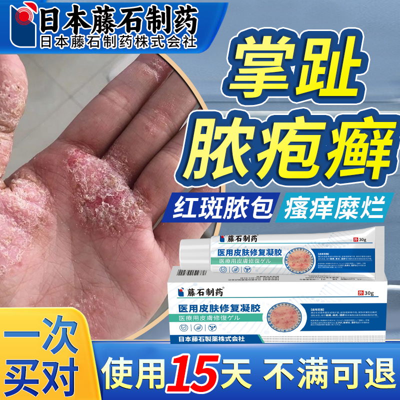 【医用级】蜕皮干裂掌跖角皮症