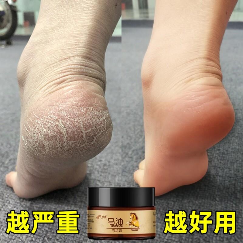 马油清足膏男女去脚气脚跟干裂脚痒脚部脱皮止痒防裂足部护理