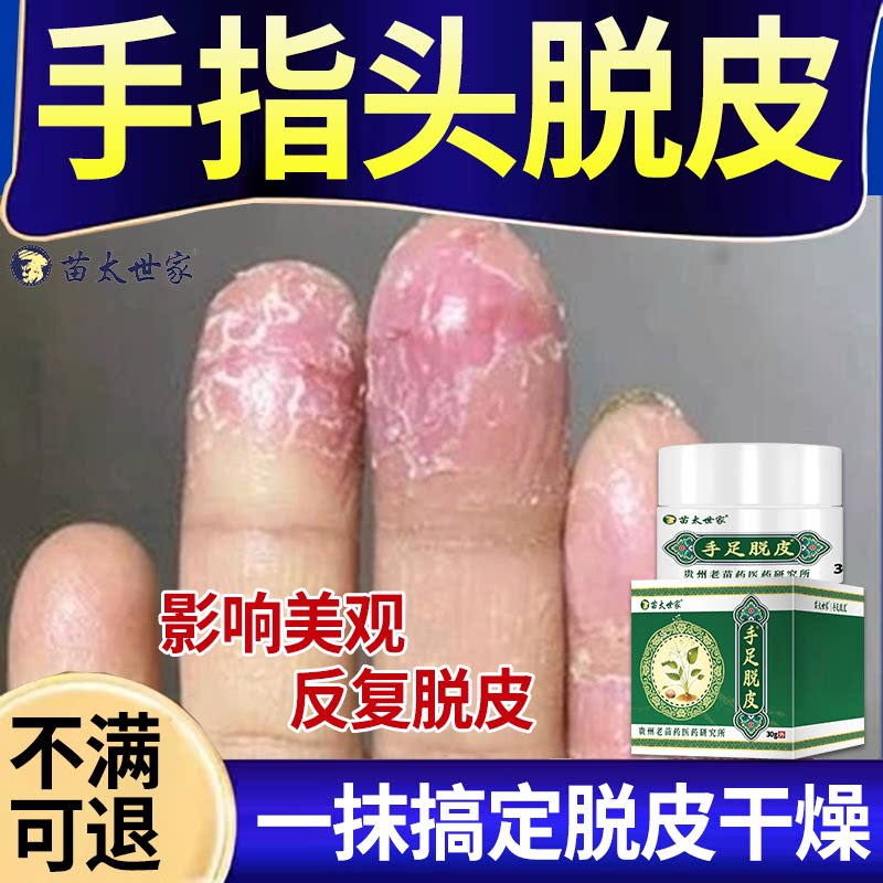 治疗手脱皮膏起皮干裂儿童吃什么维生素原因是真菌感染专用的药WT