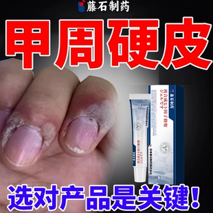 甲周硬皮甲手上长硬疙瘩老茧去除软化剂去死皮硬皮净专用药膏WT