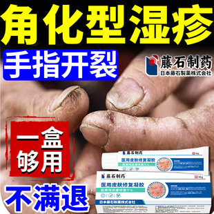 藤石制药角化型手癣膏手部湿疹脱皮干裂真菌感染手指开裂专SE