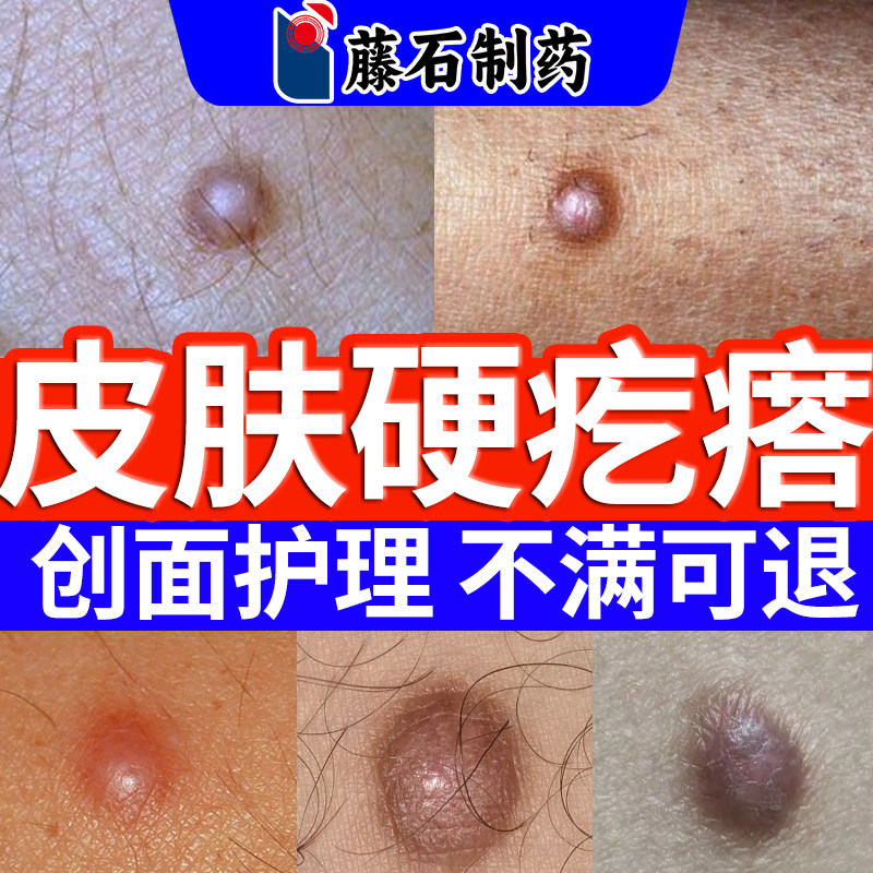 【医用级别】皮肤硬疙瘩纤维瘤