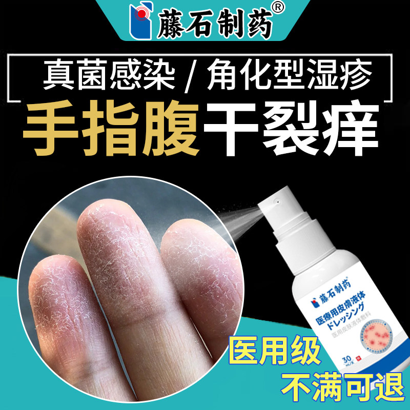 医用手指腹角化型手部湿疹手癣膏脱皮干裂真菌感染止痒根手藓SE