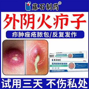 藤石制药外阴疖肿硬块拔毒膏火疖子敷贴私处长疙瘩痘痘膏药贴SE