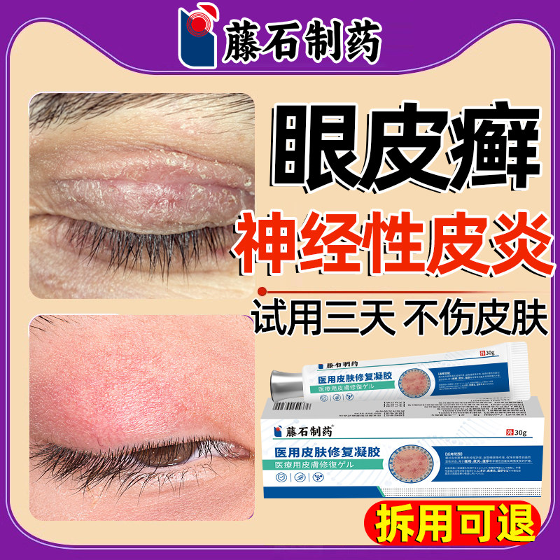 眼皮癣神经性皮炎眼皮红肿痒眼睛周围干燥起皮过敏眼角发痒掉屑SE
