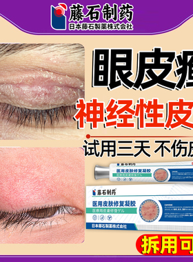 眼皮癣神经性皮炎眼皮红肿痒眼睛周围干燥起皮过敏眼角发痒掉屑SE