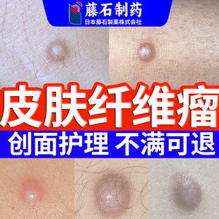 皮肤纤维瘤膏脂肪瘤膏肿硬块除可搭膏药贴皮下粉瘤疙瘩去SE
