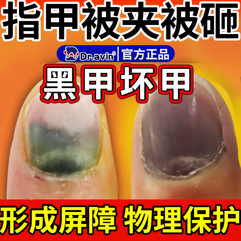 指甲被砸被夹受损创面护理压伤趾甲床断裂有淤血松动变形脱落修CS