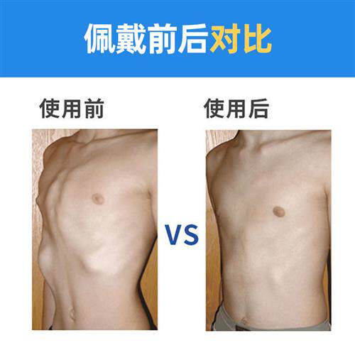 儿童鸡胸矫正器漏斗胸护胸心脏开胸术后固定板小孩幼儿肋骨外翻
