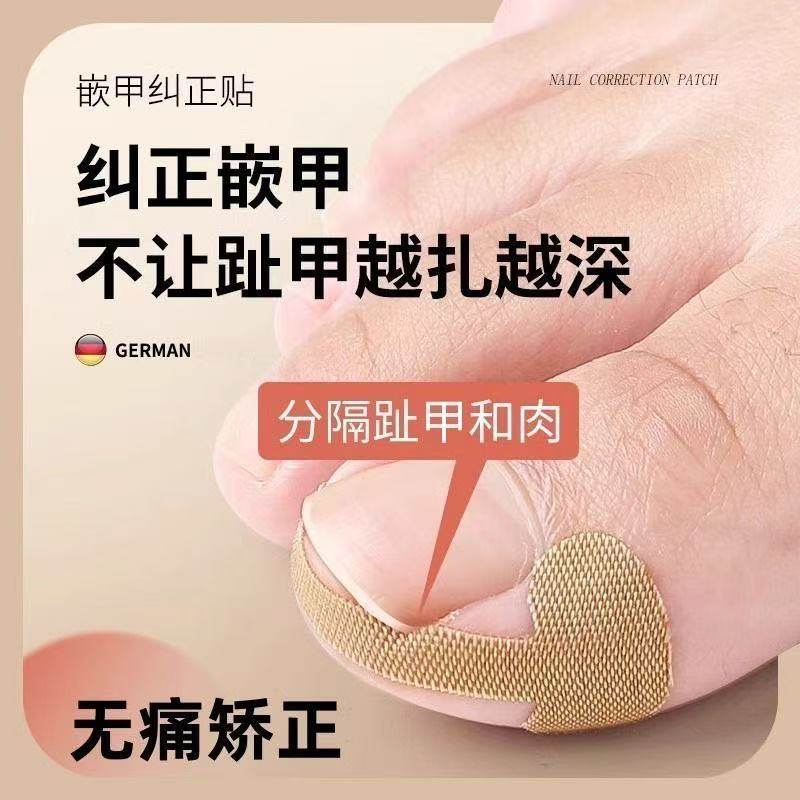 甲沟神器指甲矫正器嵌甲专用拉贴隔离脚趾甲长肉里填充垫片纠正炎,家庭/个人清洁工具,指甲钳,淘宝优惠券,粉丝福利购,淘宝优惠卷