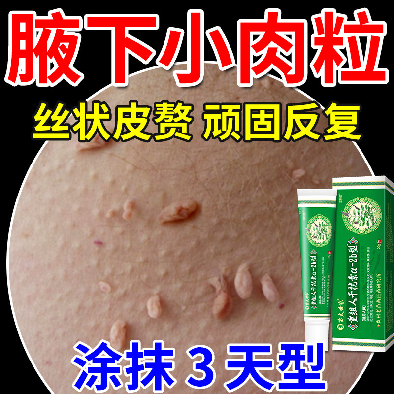 丝状疣腋下小肉粒去除神器祛去疣膏斩草除根优扁平丝状庞猴尤膏tu