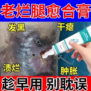 静脉曲张脉管炎老烂腿静脉炎冷敷凝胶专用可搭伤口愈合药房同款YZ