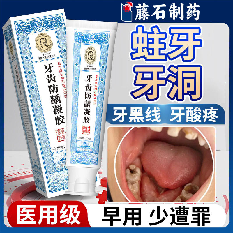 蛀牙牙洞清理牙虫龋齿专用牙膏虫牙烂牙儿童补牙缝的药房同款HT