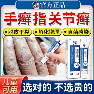 手指关节癣手癣膏脱皮干裂真菌感染角化型湿疹鹅掌风药房同款膏TU