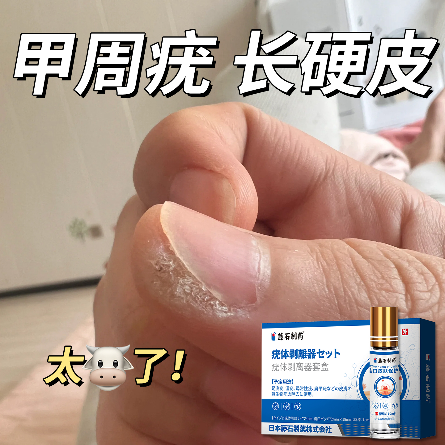 甲周疣去除手上长硬皮硬疙瘩