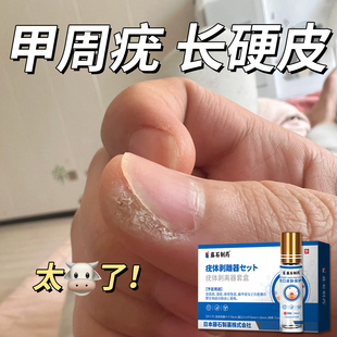 甲周疣专用手上长硬疙瘩甲周硬皮儿童贴去手指长疣药房同售膏WQ
