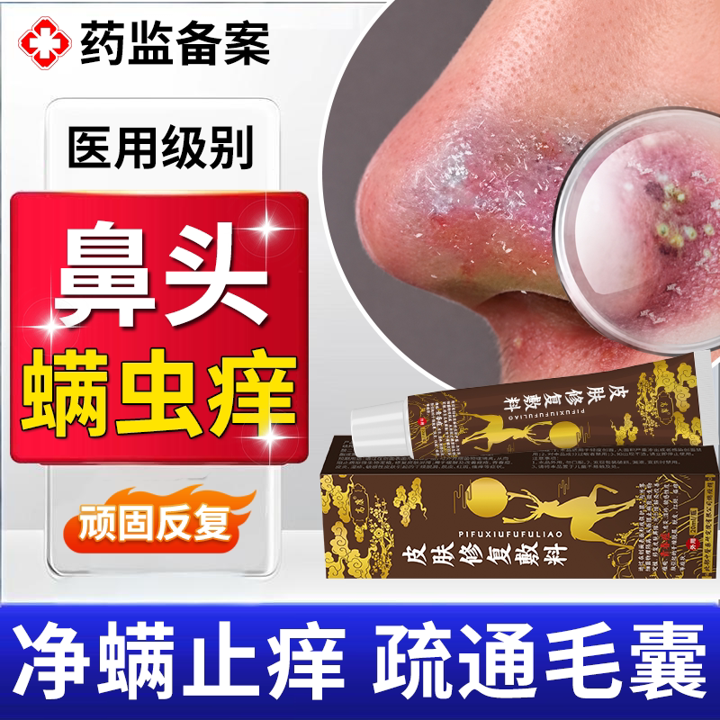 鼻子去螨虫痒脸面部除螨皮肤专用黑头祛粉刺酒糟鼻用药房同款膏TU