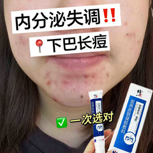 内分泌调理失调下巴反复长痘祛痘痤疮膏红肿硬块痘痘药房同款膏TU