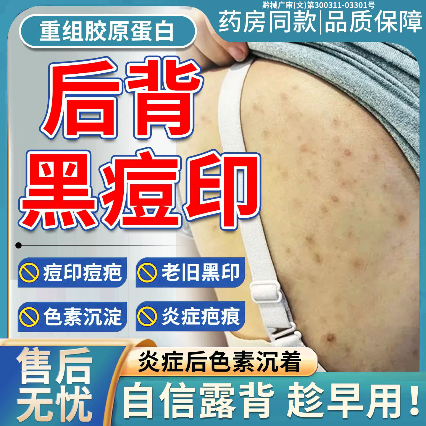 后背痘印黑色素沉淀去除祛背部晒斑疤痕淡化色斑黑印修复医用级TU