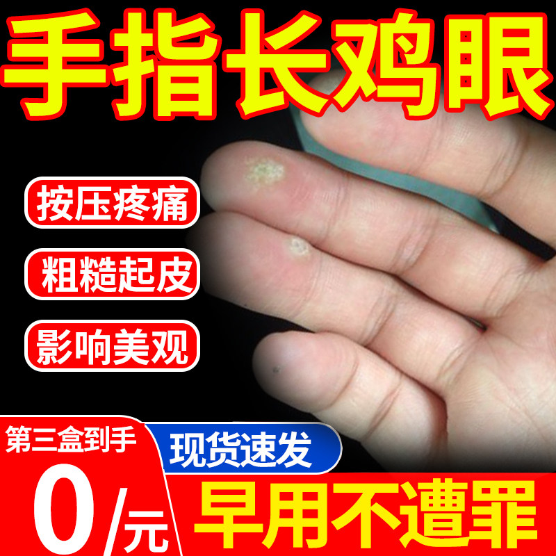 手指去除鸡眼可搭配跖疣专用药房同款膏水保护贴去神器根肉刺jh