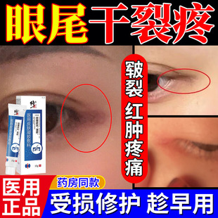 眼角发炎干裂红肿痒眼皮癣眼睛周围眼角藓痒干燥起皮神经性皮炎TU