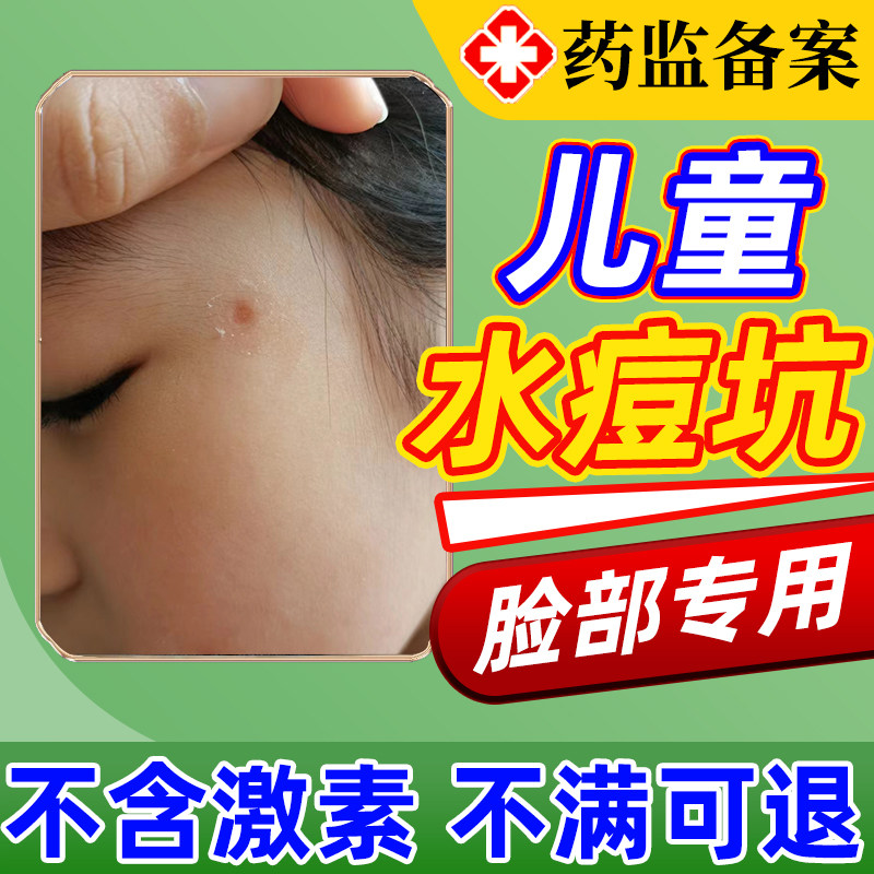 儿童脸部水痘疤痕可搭配修复水痘坑生长因子使用凹陷修复除疤膏jh