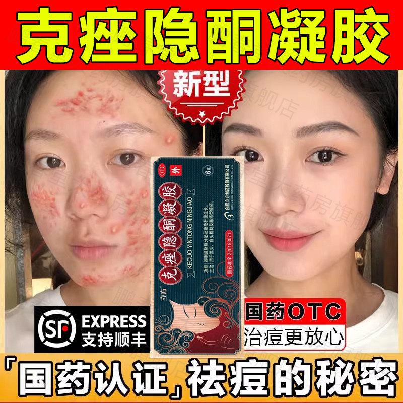 立方克痤隐酮凝胶15g痤疮黑头白头粉刺克座克痤酮隐凝祛痘药膏ql