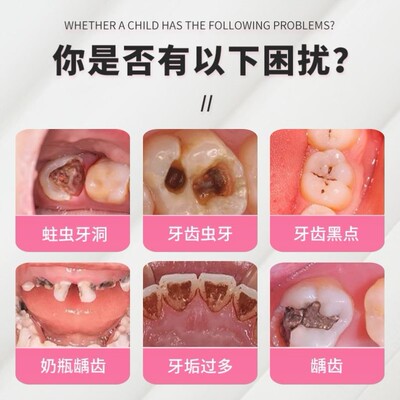 儿童小孩子宝宝婴幼儿蛀牙牙洞清理虫牙清理牙洞牙齿黑洞清洁神器
