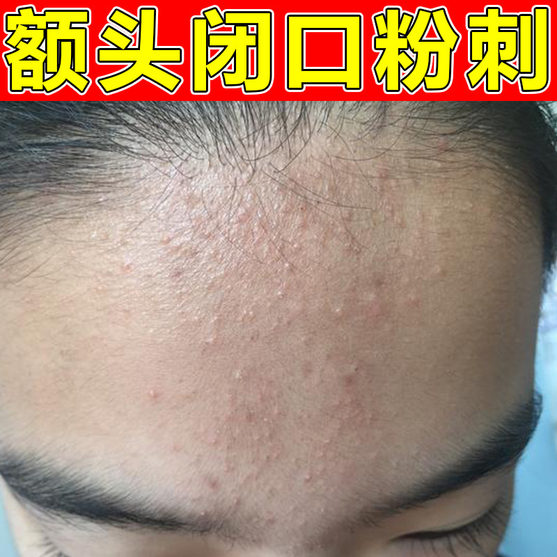 额头密麻小疙瘩闭口粉刺的黑头上火痘软膏