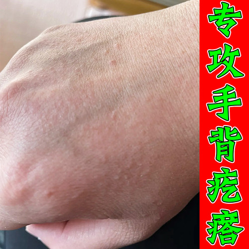 手背痒手背长小疙瘩红点痒的抓挠不停专用乳膏