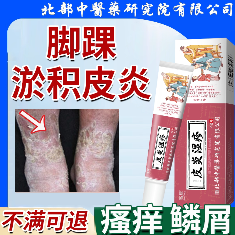 脚踝淤积性皮炎静脉曲张可搭药膏皮炎湿痒干燥痒皮肤痒真菌感染ik