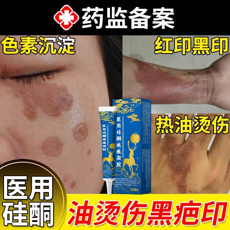 热油油烫伤去疤膏疤痕修复去黑印黑色素沉淀除疤膏医用硅酮凝胶VQ