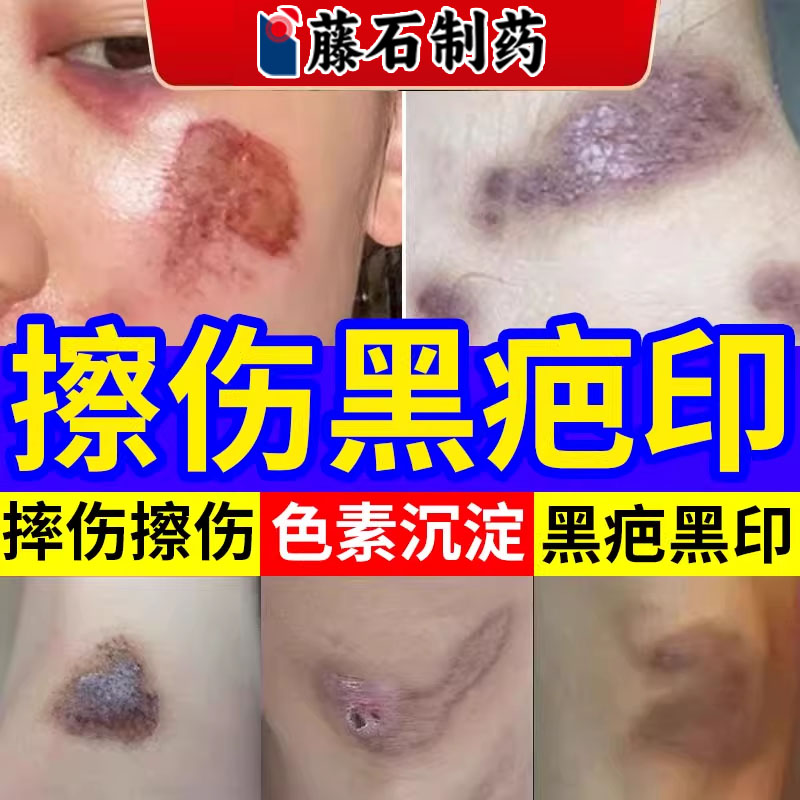 【儿童可用】摔伤擦伤去黑疤黑印