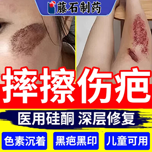 摔伤擦伤疤痕修复除疤膏去黑色素沉淀小孩儿童脸部祛疤专用淡化WQ