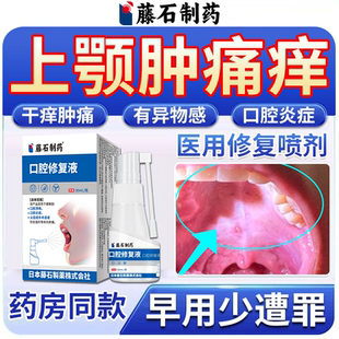 上颚痒肿痛发炎口腔黏膜炎症修复喷剂上壁水肿烫伤溃疡药房同款TU
