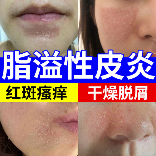 脂溢性皮炎洗面奶---医用级别