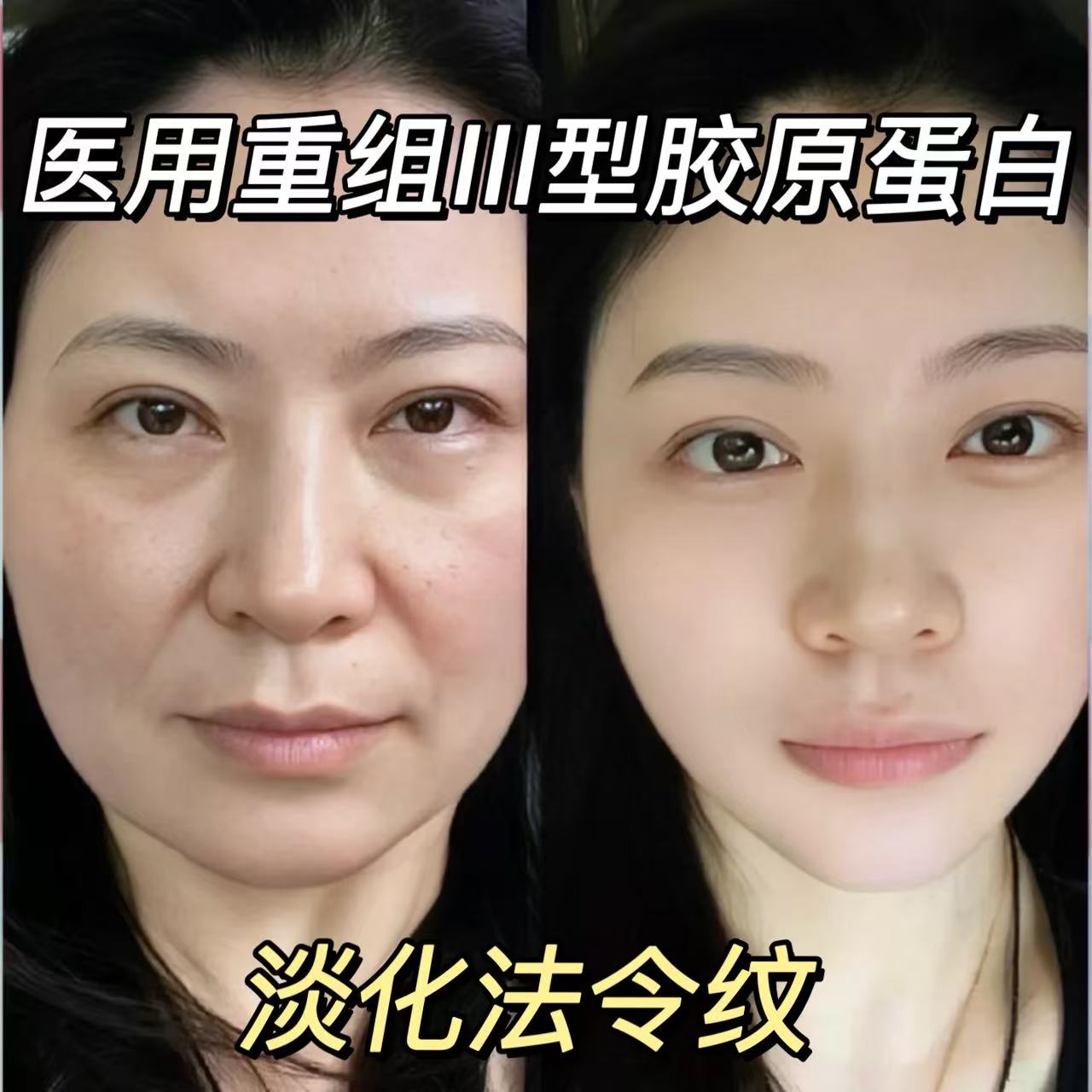 藤石制药-胶原蛋白-淡化法令纹