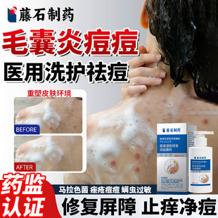 后背上长痘痘马色马拉色菌毛囊炎沐浴露专用除螨祛痘痒药房同款YZ