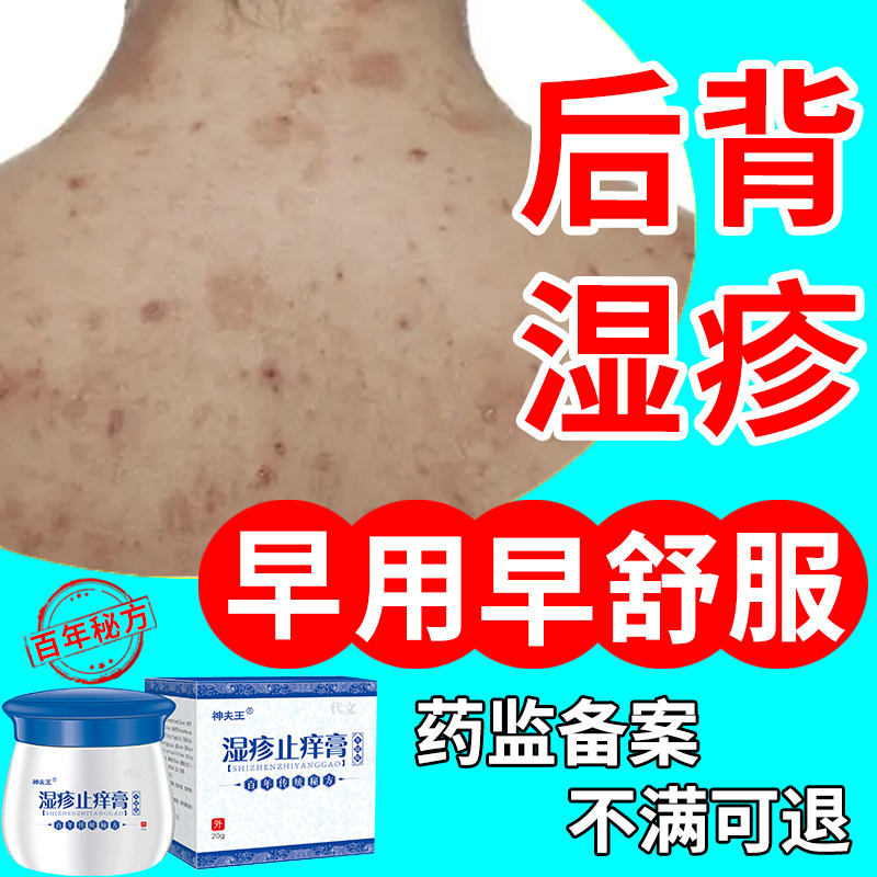 后背皮肤湿疹止痒去顽固皮炎根背部背后真菌感染克星专用除湿膏wq