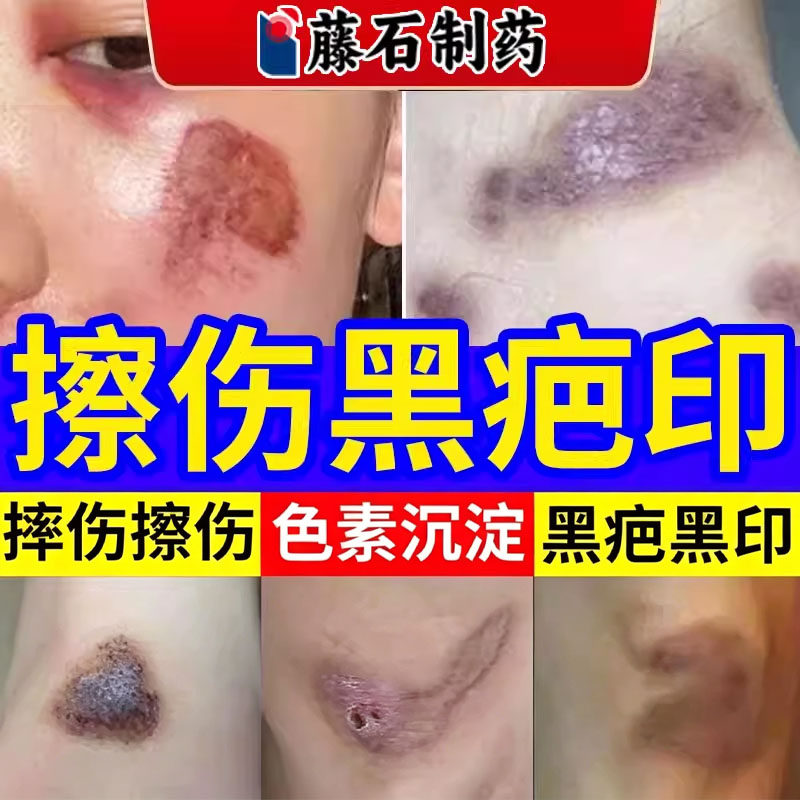 擦伤摔伤疤痕修复除疤膏去脸上伤疤印去除黑色素沉淀淡化祛疤膏TU