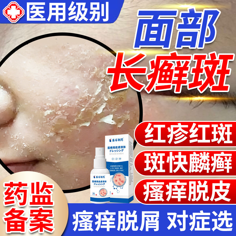 脸上长癣真菌感染铜钱癣体癣脸部红斑瘙痒起皮红痒干燥有碎屑XG