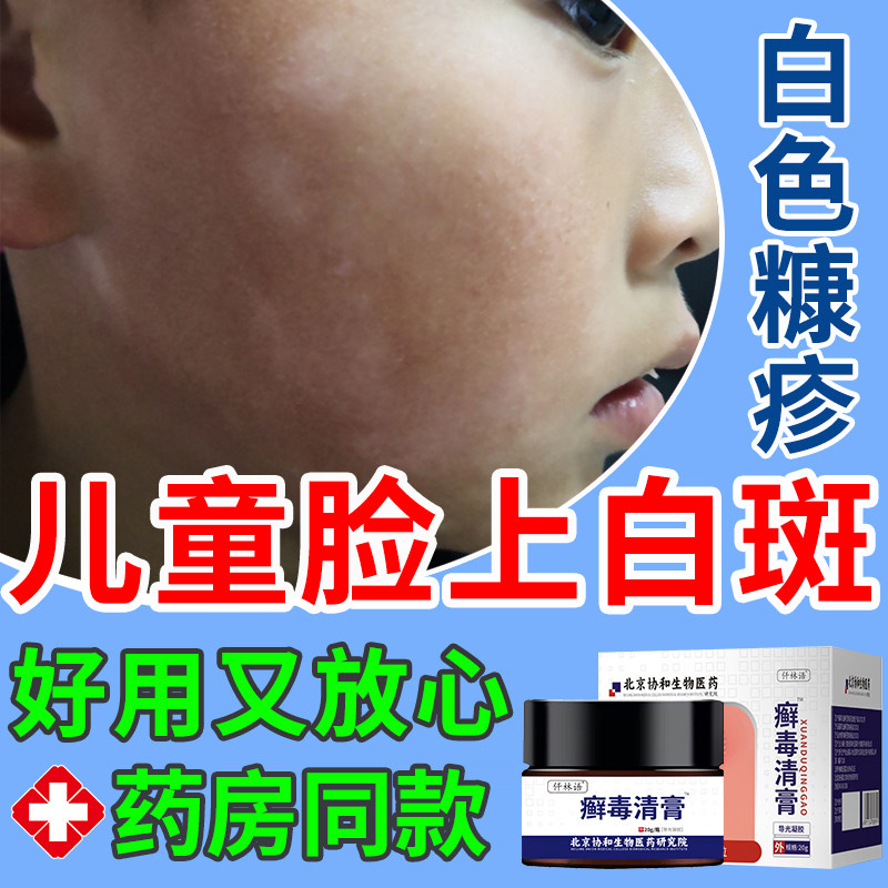儿童脸上长白斑白色糠疹桃花癣鳞屑瘙痒汗斑点斑块可搭配药膏用wq