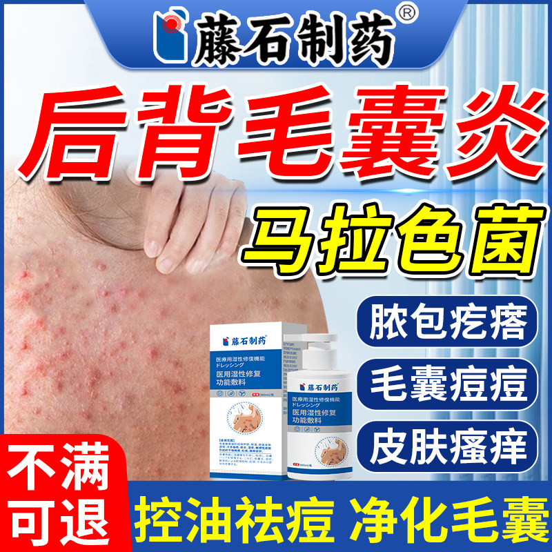 背后长痘痘后背毛囊炎专用沐浴露治马拉色菌毛囊炎真菌感染长痘AZ