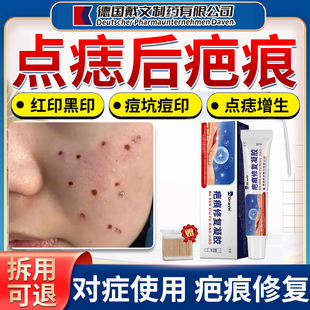 点痣后去疤痕修复膏祛疤膏红印黑印色素沉淀增生点斑可搭祛疤贴AZ